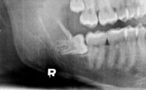 An impacted wisdom tooth is positioned perpendicular to the adjacent teeth and will need to be removed.